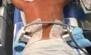 3D Lipo